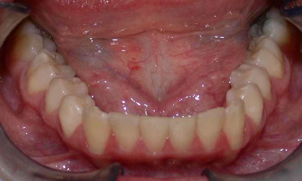 Floor Of Mouth Swollen On One Side Home Alqu